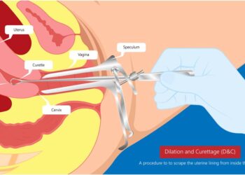 Dilation Curettage