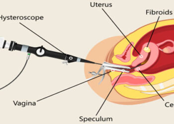 Hysteroscopy