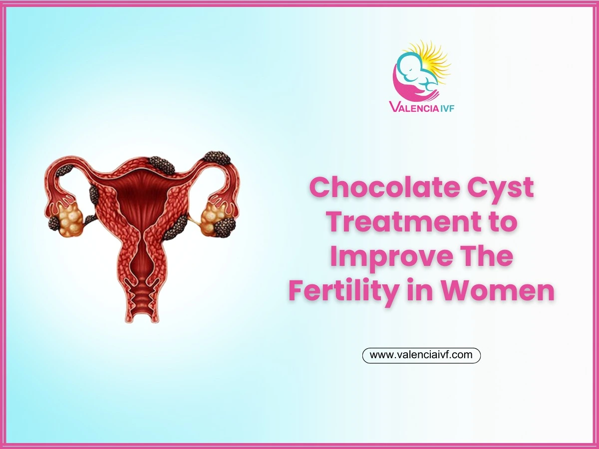 Chocolate Cyst Treatment to Improve Fertility in Women