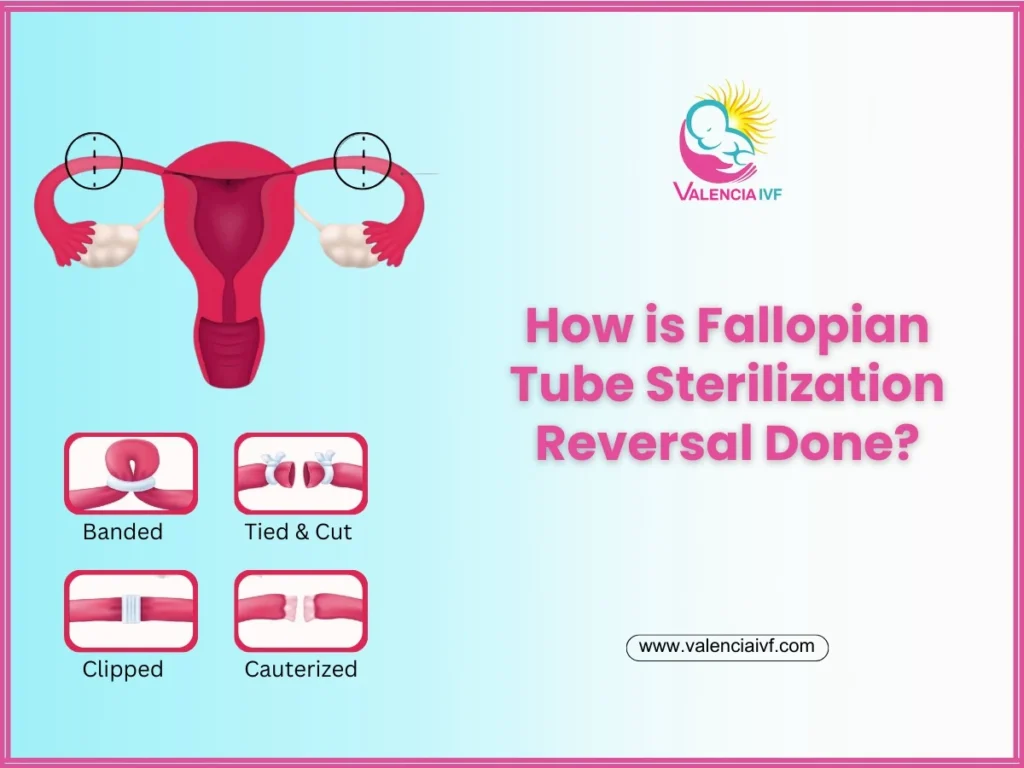 How is Fallopian Tube Sterilization Reversal Done?